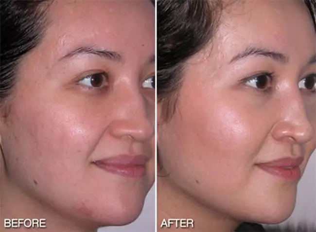 Skin Resurfacing