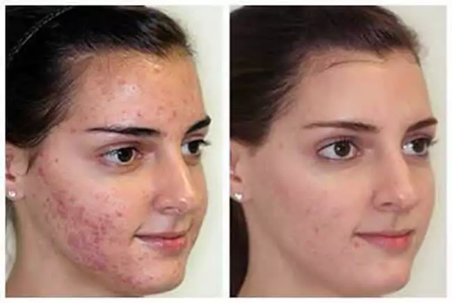 Skin Resurfacing